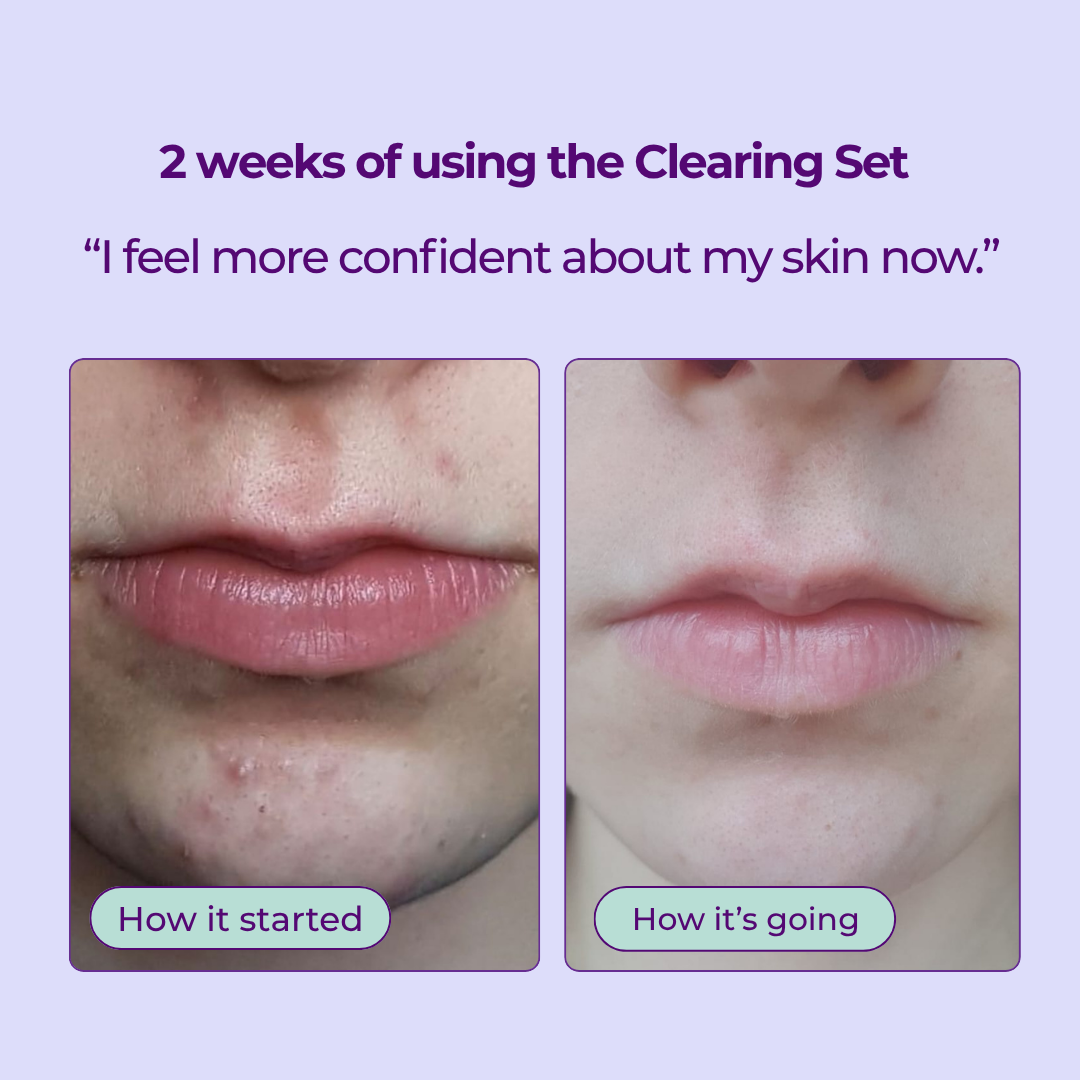 3-Step Acne & Clearing Skincare Set